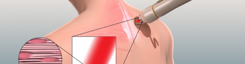 Om laserbehandling av muskelknutor