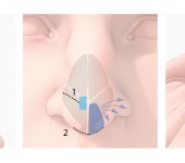 Nose surgery strategy comparison