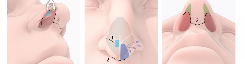 Nose surgery strategy comparison